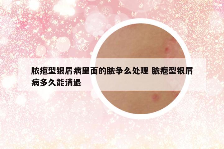脓疱型银屑病里面的脓争么处理 脓疱型银屑病多久能消退