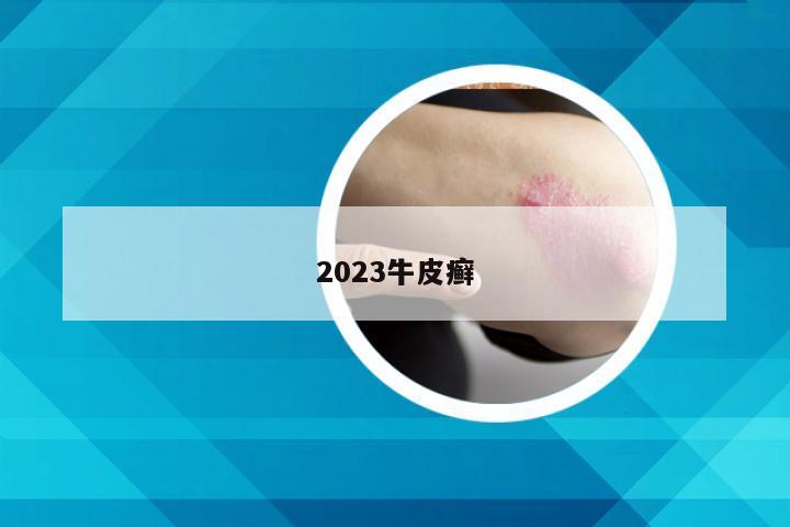 2023牛皮癣