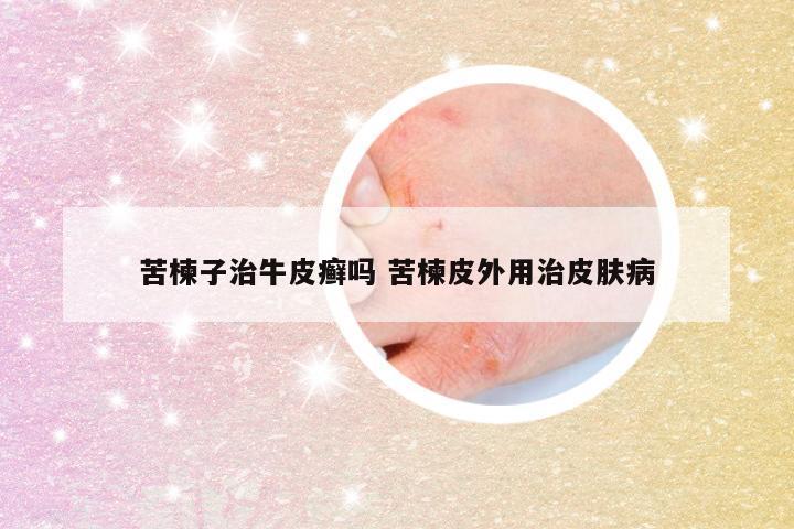 苦楝子治牛皮癣吗 苦楝皮外用治皮肤病