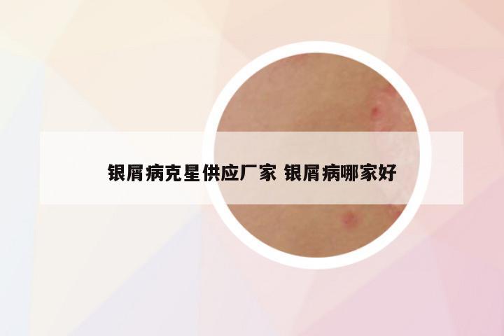 银屑病克星供应厂家 银屑病哪家好