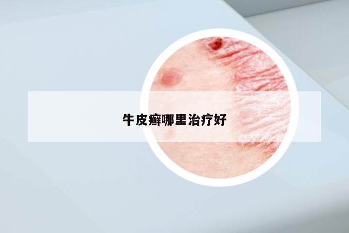 牛皮癣哪里治疗好
