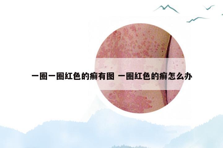 一圈一圈红色的癣有图 一圈红色的癣怎么办