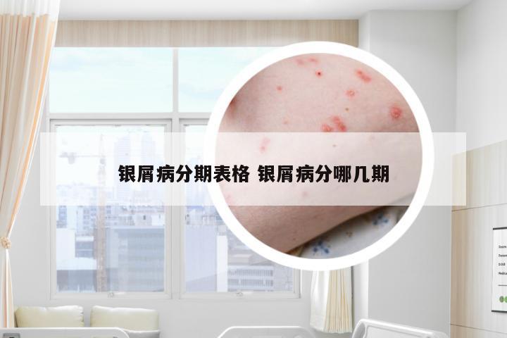 银屑病分期表格 银屑病分哪几期