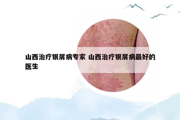 山西治疗银屑病专家 山西治疗银屑病最好的医生
