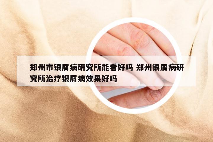 郑州市银屑病研究所能看好吗 郑州银屑病研究所治疗银屑病效果好吗
