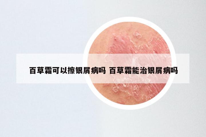 百草霜可以擦银屑病吗 百草霜能治银屑病吗