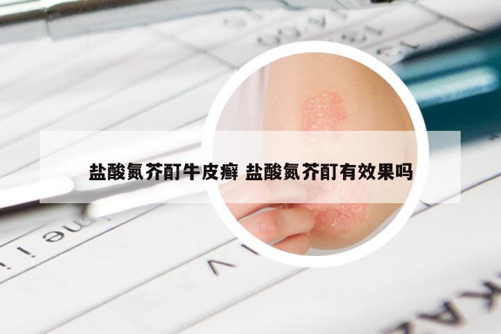 盐酸氮芥酊牛皮癣 盐酸氮芥酊有效果吗