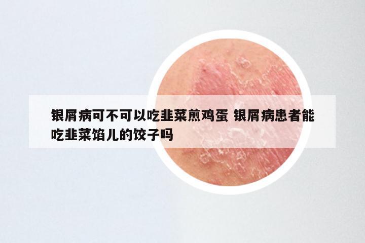 银屑病可不可以吃韭菜煎鸡蛋 银屑病患者能吃韭菜馅儿的饺子吗