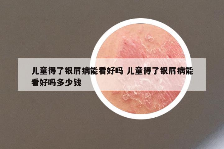 儿童得了银屑病能看好吗 儿童得了银屑病能看好吗多少钱