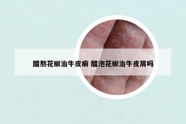 醋熬花椒治牛皮癣 醋泡花椒治牛皮屑吗