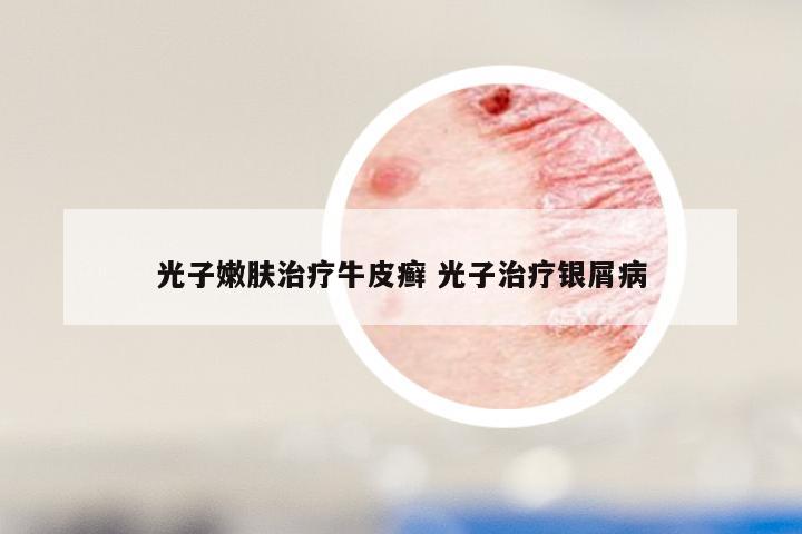 光子嫩肤治疗牛皮癣 光子治疗银屑病