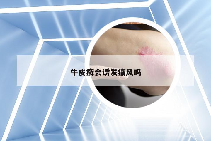 牛皮癣会诱发痛风吗