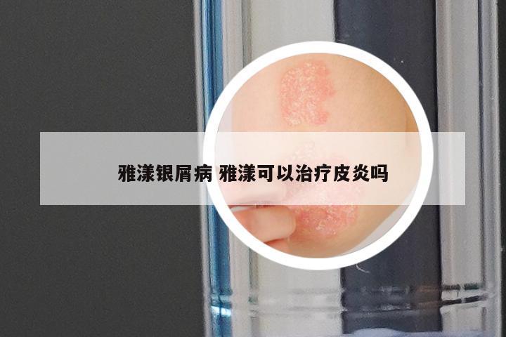 雅漾银屑病 雅漾可以治疗皮炎吗