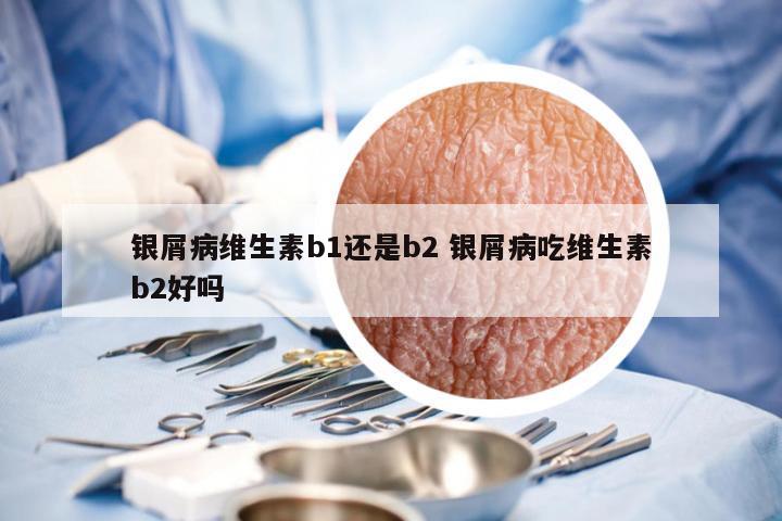 银屑病维生素b1还是b2 银屑病吃维生素b2好吗