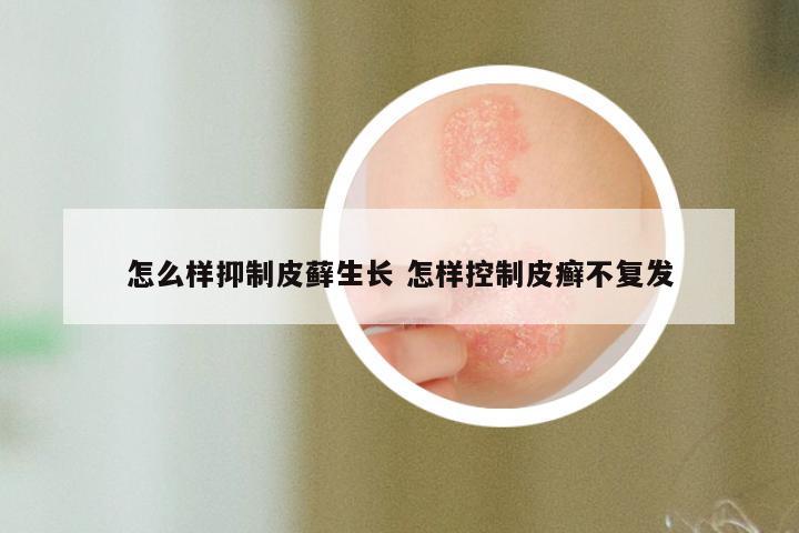 怎么样抑制皮藓生长 怎样控制皮癣不复发