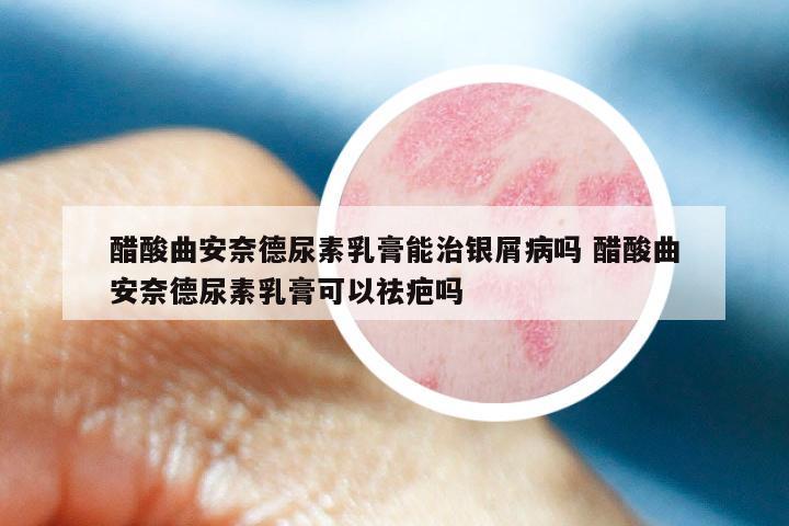 醋酸曲安奈德尿素乳膏能治银屑病吗 醋酸曲安奈德尿素乳膏可以祛疤吗