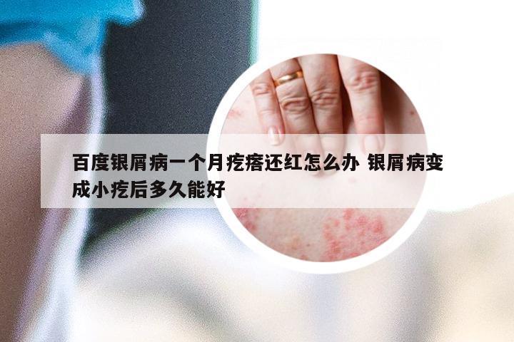 百度银屑病一个月疙瘩还红怎么办 银屑病变成小疙后多久能好