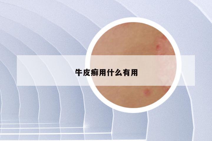 牛皮癣用什么有用