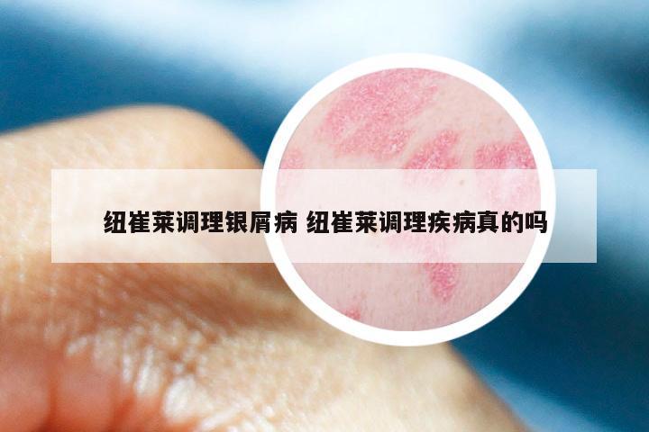 纽崔莱调理银屑病 纽崔莱调理疾病真的吗