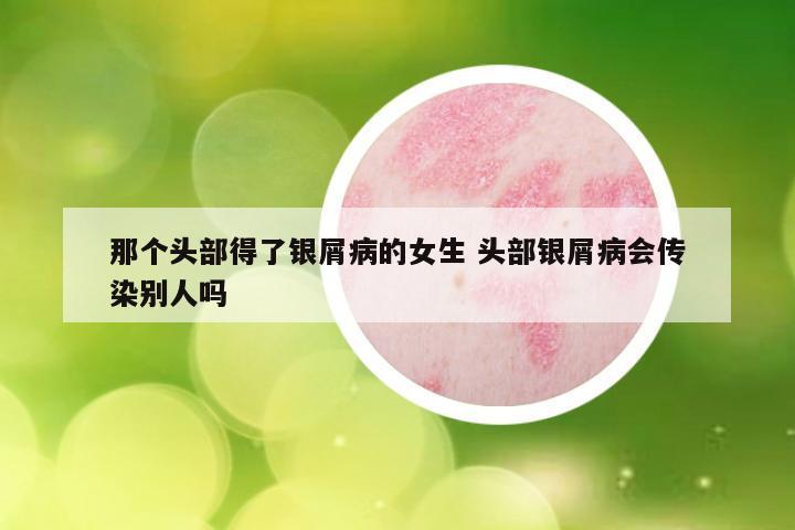 那个头部得了银屑病的女生 头部银屑病会传染别人吗