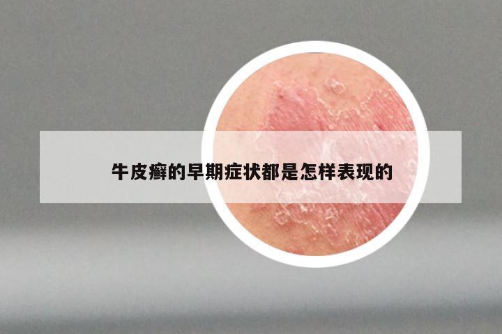 牛皮癣的早期症状都是怎样表现的
