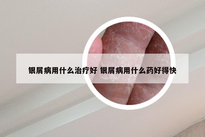 银屑病用什么治疗好 银屑病用什么药好得快