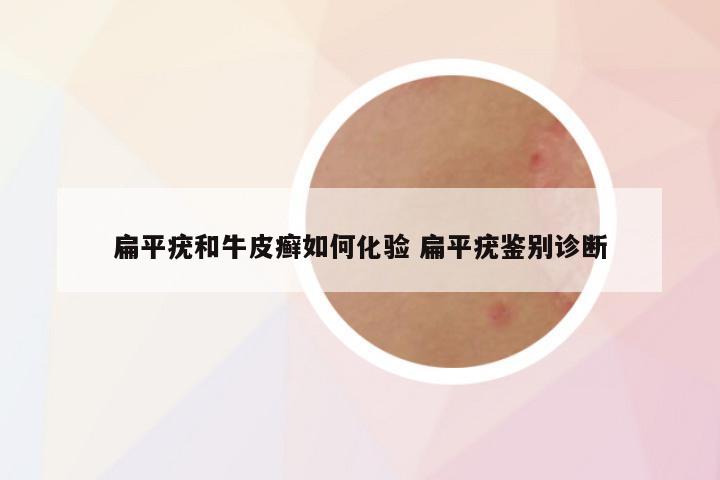 扁平疣和牛皮癣如何化验 扁平疣鉴别诊断