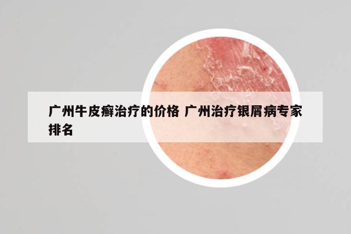 广州牛皮癣治疗的价格 广州治疗银屑病专家排名