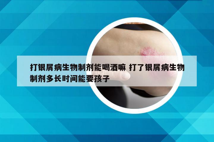 打银屑病生物制剂能喝酒嘛 打了银屑病生物制剂多长时间能要孩子