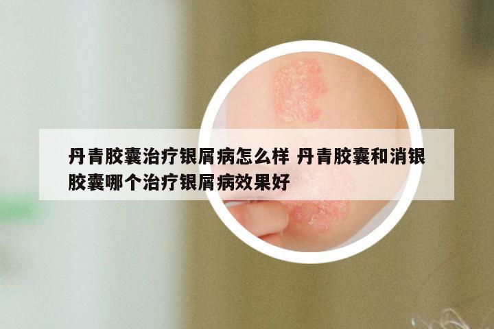 丹青胶囊治疗银屑病怎么样 丹青胶囊和消银胶囊哪个治疗银屑病效果好