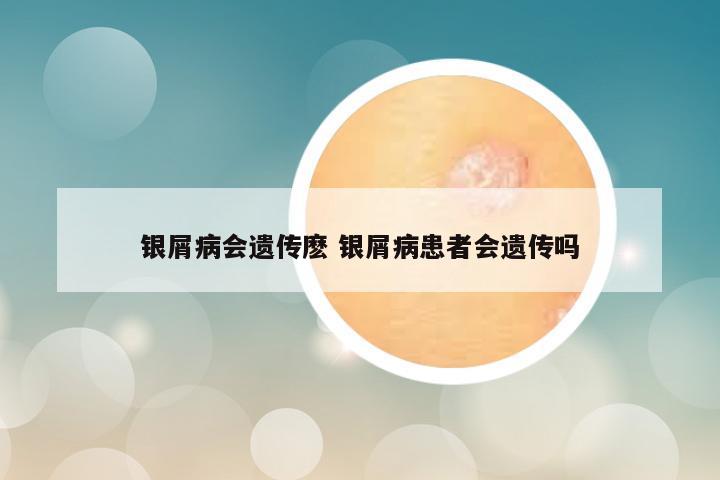 银屑病会遗传麽 银屑病患者会遗传吗
