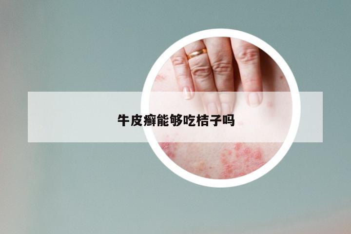 牛皮癣能够吃桔子吗