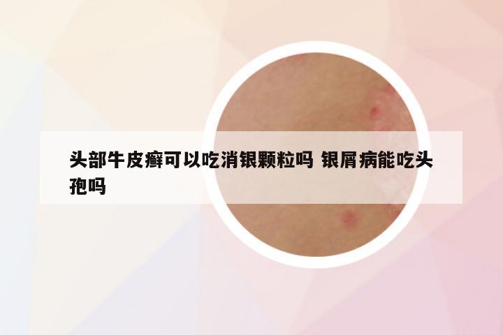 头部牛皮癣可以吃消银颗粒吗 银屑病能吃头孢吗