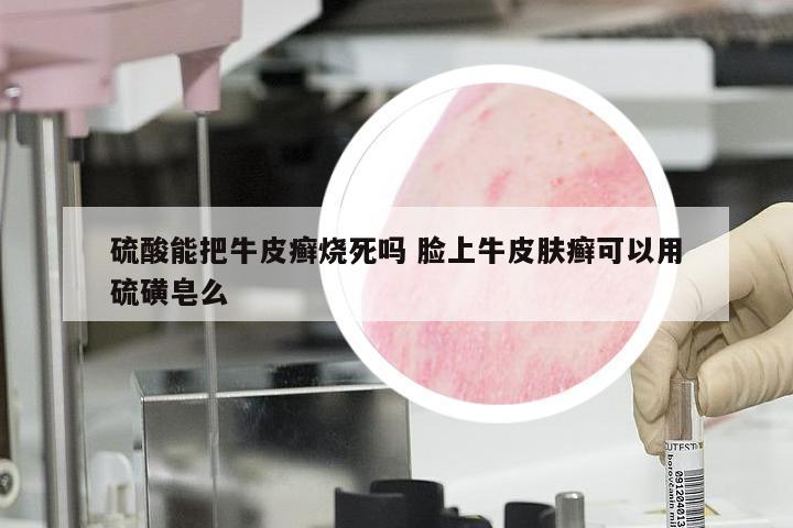硫酸能把牛皮癣烧死吗 脸上牛皮肤癣可以用硫磺皂么