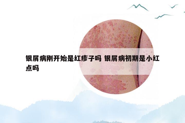 银屑病刚开始是红疹子吗 银屑病初期是小红点吗