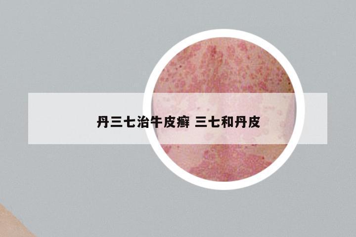 丹三七治牛皮癣 三七和丹皮