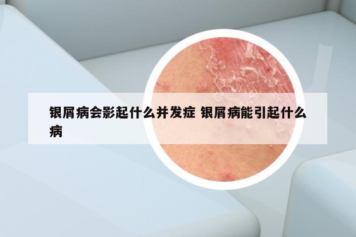 银屑病会影起什么并发症 银屑病能引起什么病