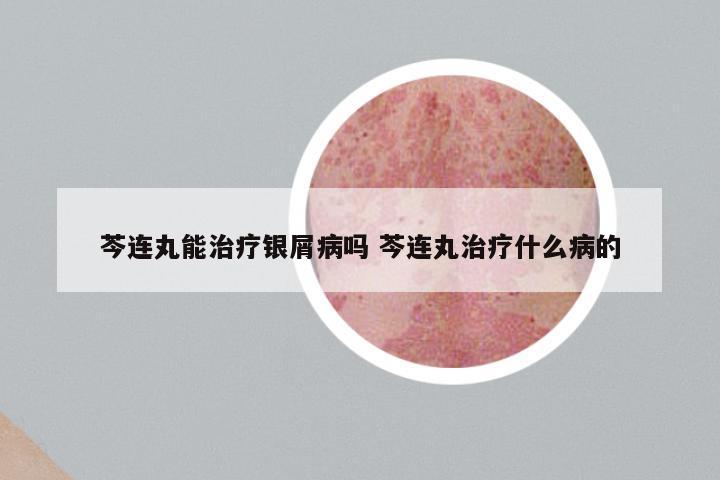 芩连丸能治疗银屑病吗 芩连丸治疗什么病的