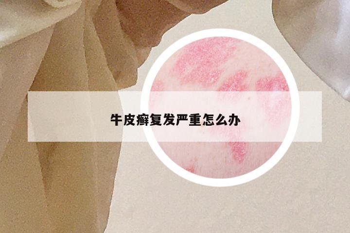 牛皮癣复发严重怎么办