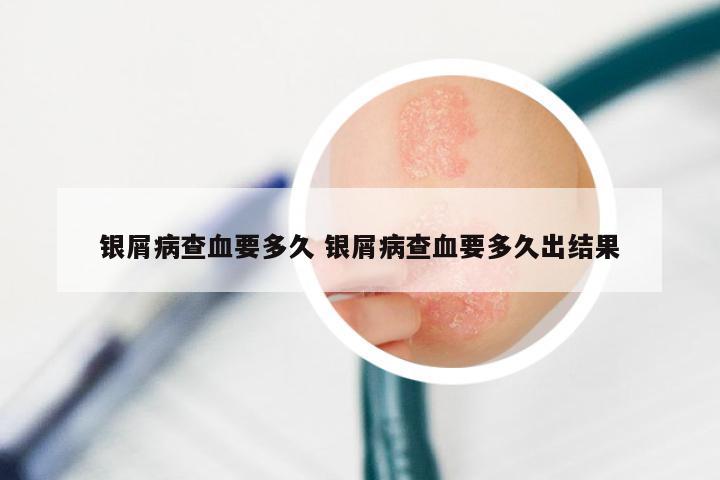 银屑病查血要多久 银屑病查血要多久出结果