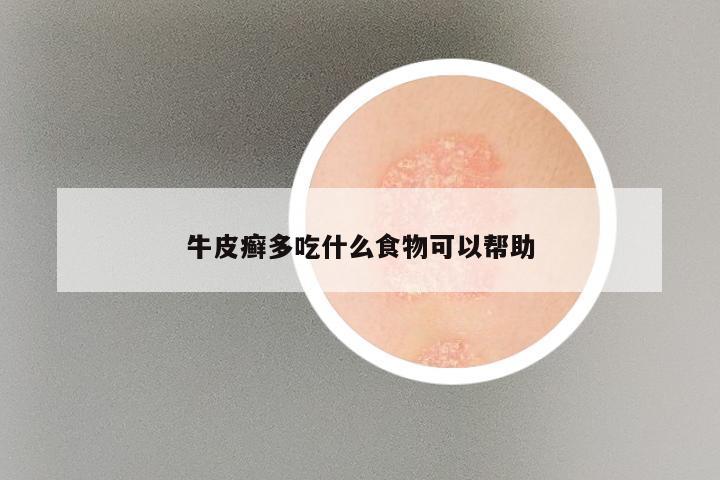 牛皮癣多吃什么食物可以帮助