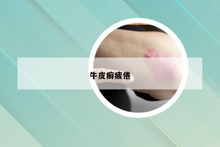 牛皮癣疲倦