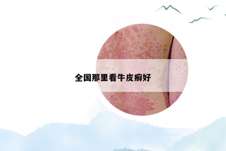 全国那里看牛皮癣好