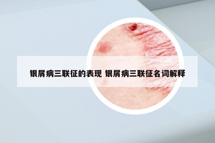 银屑病三联征的表现 银屑病三联征名词解释