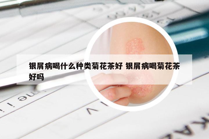 银屑病喝什么种类菊花茶好 银屑病喝菊花茶好吗