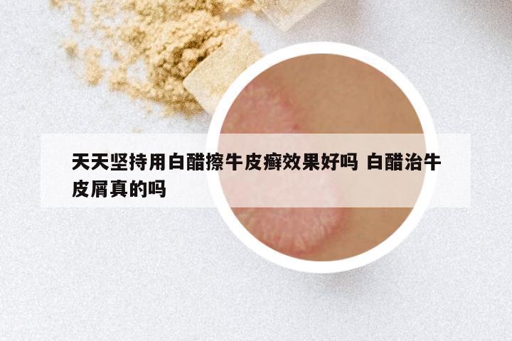 天天坚持用白醋擦牛皮癣效果好吗 白醋治牛皮屑真的吗