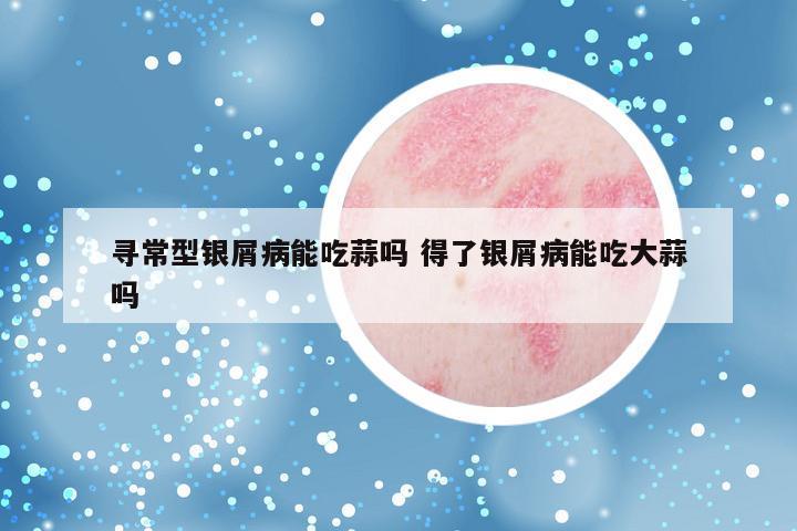 寻常型银屑病能吃蒜吗 得了银屑病能吃大蒜吗