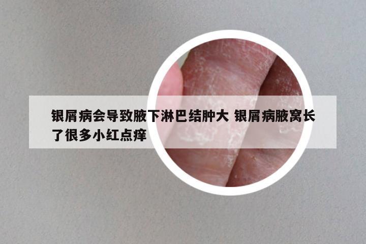 银屑病会导致腋下淋巴结肿大 银屑病腋窝长了很多小红点痒