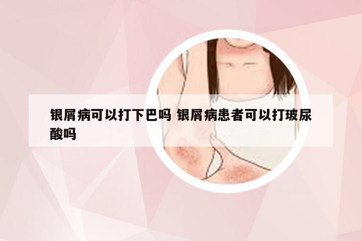 银屑病可以打下巴吗 银屑病患者可以打玻尿酸吗