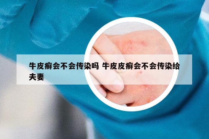 牛皮癣会不会传染吗 牛皮皮癣会不会传染给夫妻